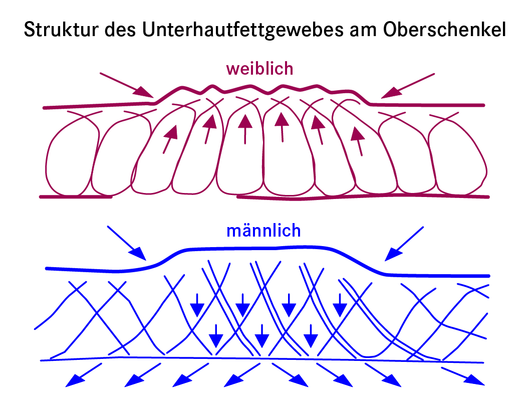 Struktur des Unterhautfettgewebes am Oberschenkel: männlich und weiblich
