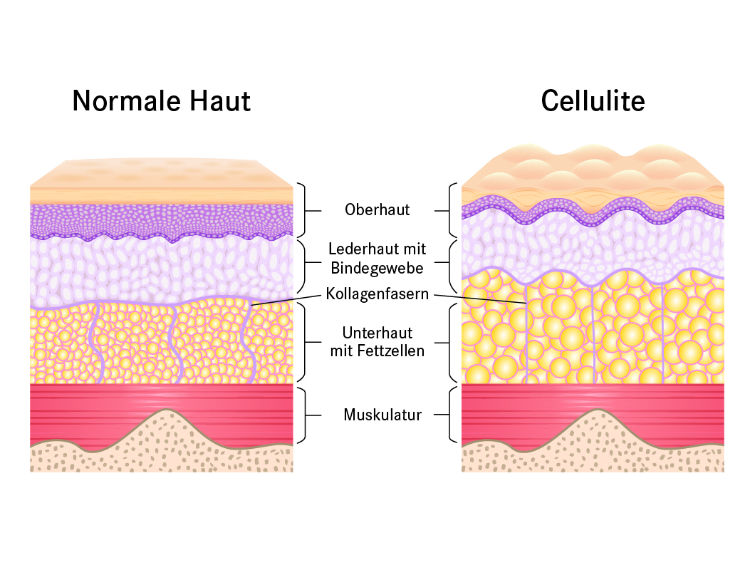 Normale Haut vs. Cellulite